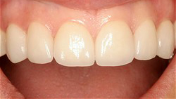 No Prep Porcelain Veneers