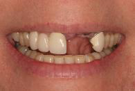 Dental Implants: Before