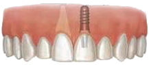 Dental Implants: Crown